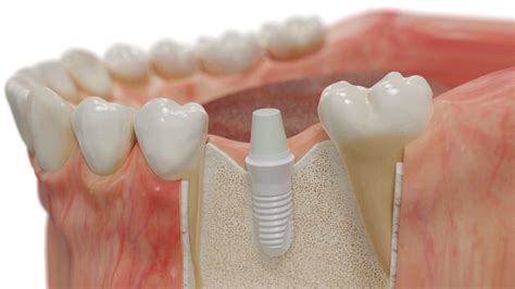  Ceramics: ¿El material del futuro para implantes ortopédicos de alto rendimiento?